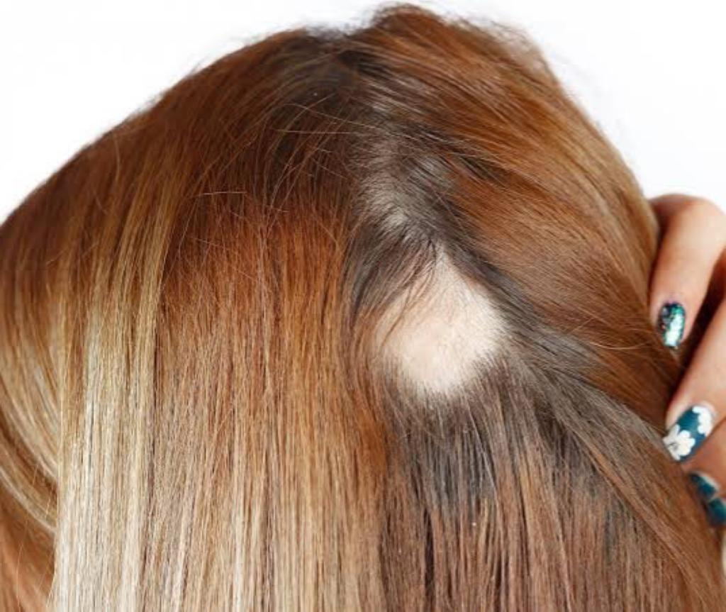 Você conhece os tipos de Alopecia? – Blog S'ollér Brasil